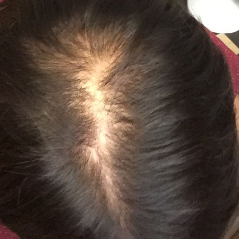 Kann Das Haar Lichter Werden Auch Wenn Kein Ha Besteht Mit Bild Haare Licht Haarausfall