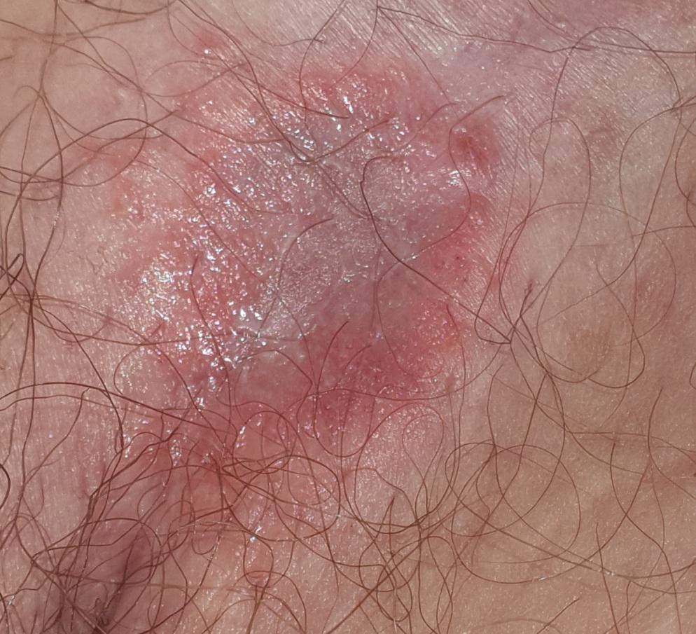 Kann das Hautpilz sein? (Gesundheit und Medizin)