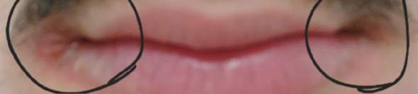 Kann das ein Allergie sein weil es ist schön das 5mal in dieses Jahr, dass mein Lippen so rot wird und weh tut?