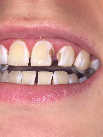 Kann Der Zahn Mit Fullung Repariert Werden Angst Zahne Zahnarzt