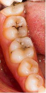 Kann der Zahnarzt so ein Karies entfernen(Zahn ohne Loch)? (Gesundheit und  Medizin)