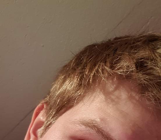 Kann Diese Warze In Meinem Gesicht Entfernt Werden Gesundheit Warzenentfernung Kann Diese Warze In Meinem Gesicht Entfernt Werden Gesundheit Warzenentfernung