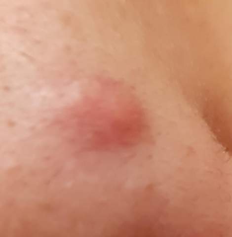 Kann diesen Pickel ausdrücken und wie am besten? (Gesundheit und Medizin, Haut) pickel im ausschnitt