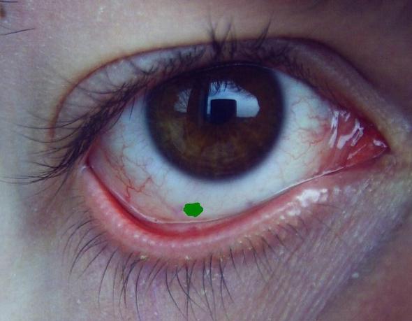 Dreck Im Auge