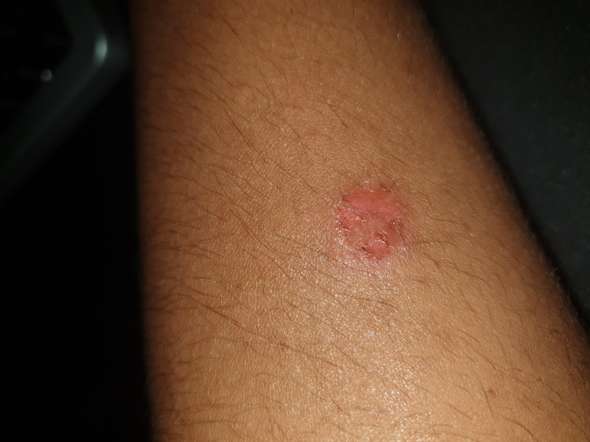 Kann Es Sein Das Ich Hautkrebs Oder Was Anderes Habe Gesundheit Und Medizin Kann Es Sein Das Ich Hautkrebs Oder Was Anderes Habe Gesundheit Und Medizin