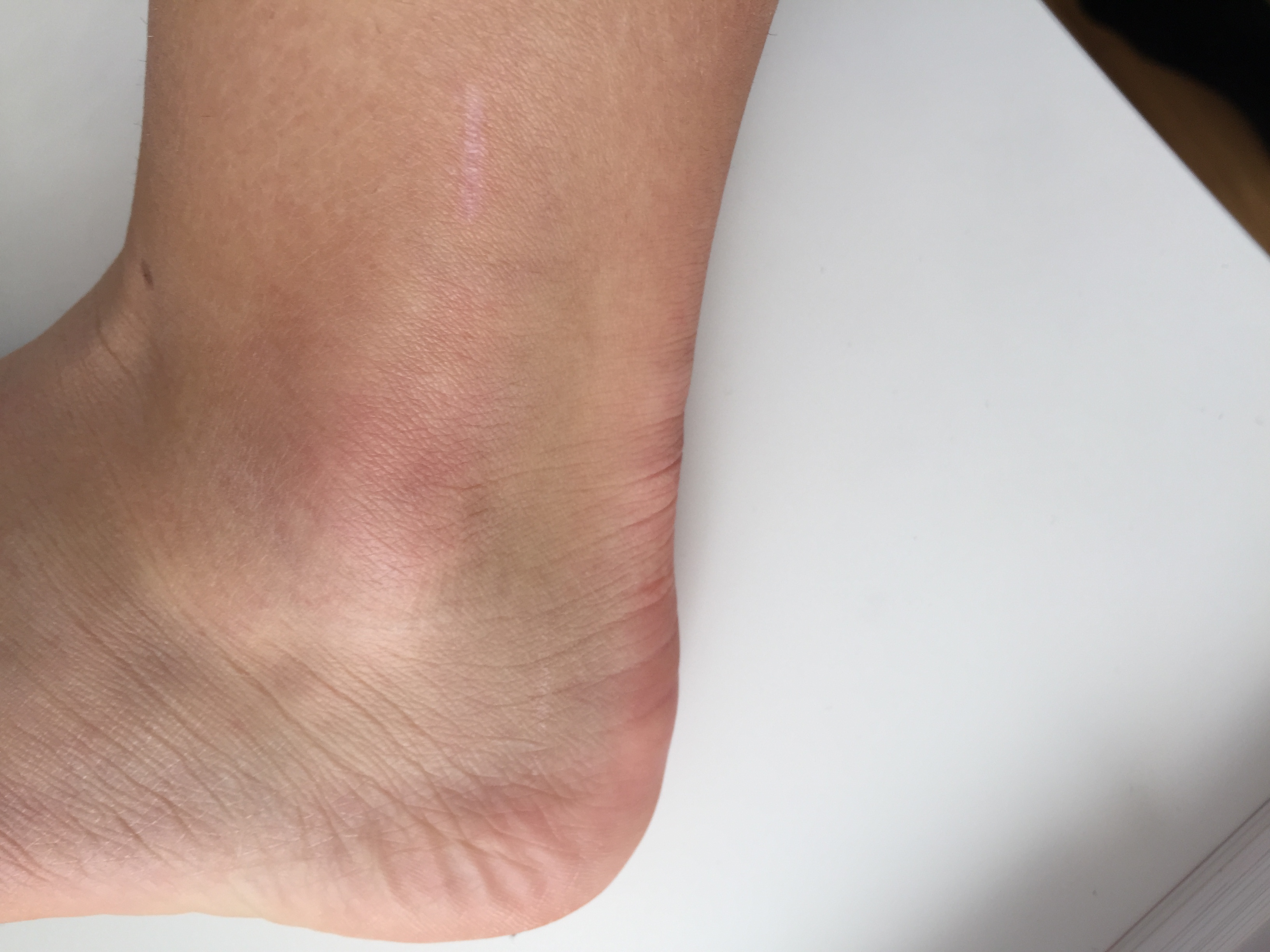 Kann es sein das sich dass Gewebe um den Knöchel nach einem angerissenen Band verändert ...