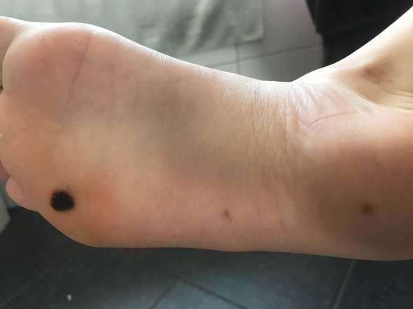 Fußsohle muttermal Erfahrungsbericht zu