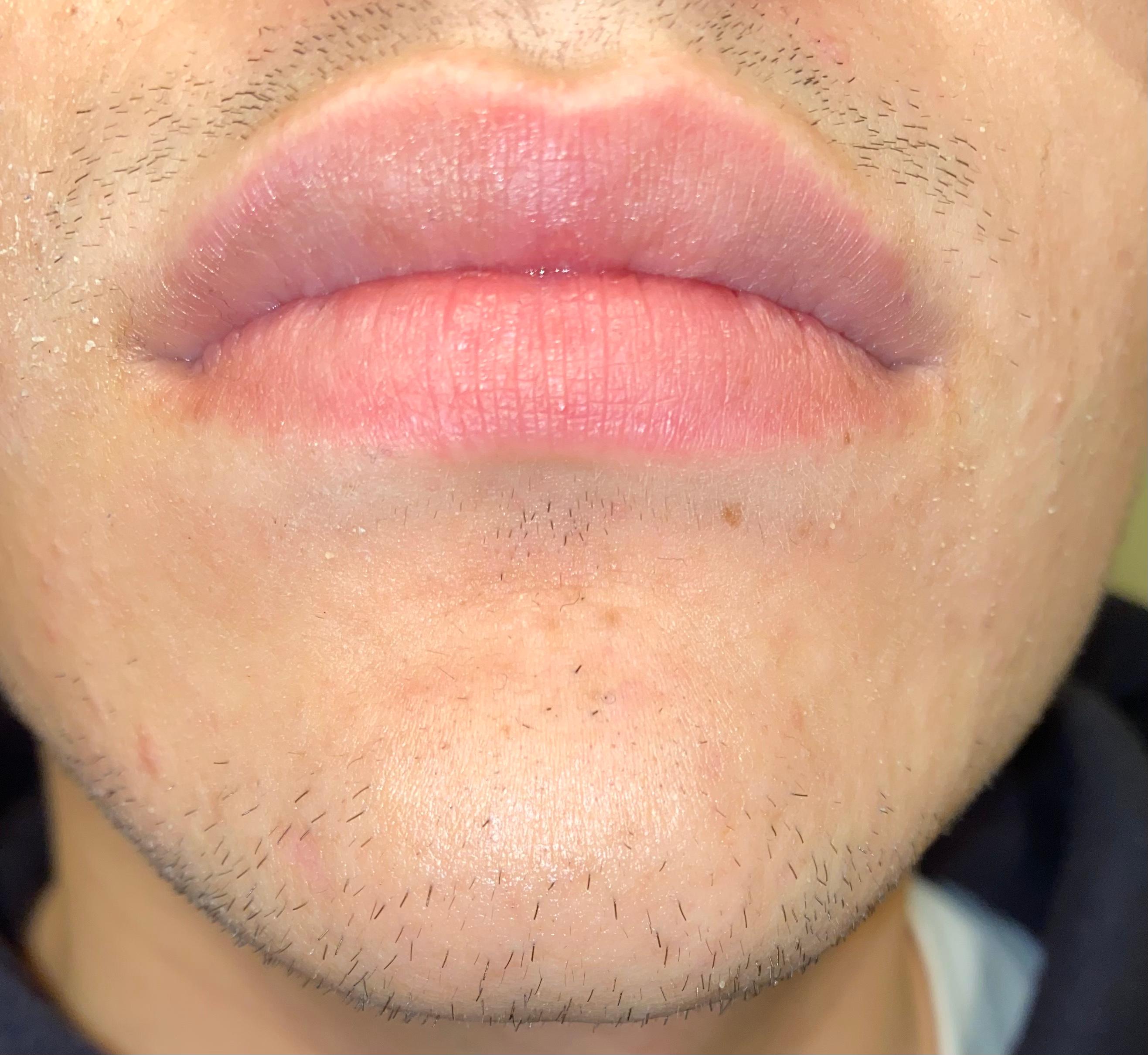 haare bart minoxidil