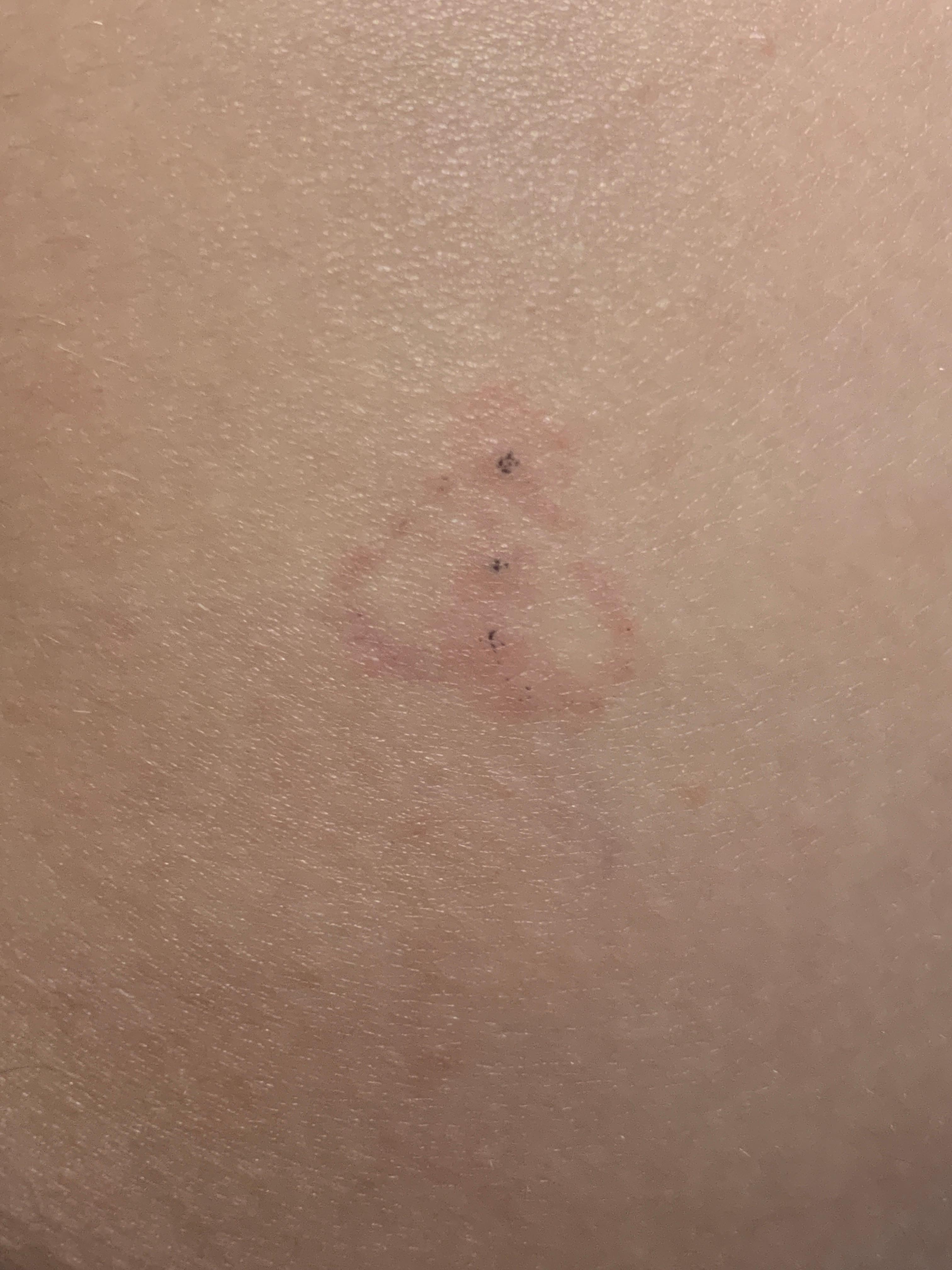 Kann ich durch diese drei Mini tatto Punkte eine blutvergiftung