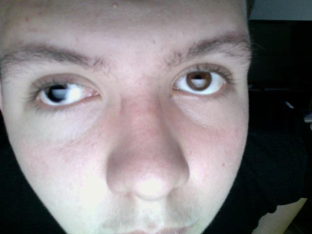 Kann Ich Eine Schieloperation Machen Wenn Mein Schielendes Auge Verletzt Ist Augen Operation Schielen Kann Ich Eine Schieloperation Machen Wenn Mein Schielendes Auge Verletzt Ist Augen Operation Schielen
