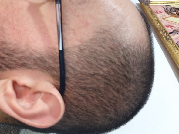 kann ich meine haare trotz haarausfall