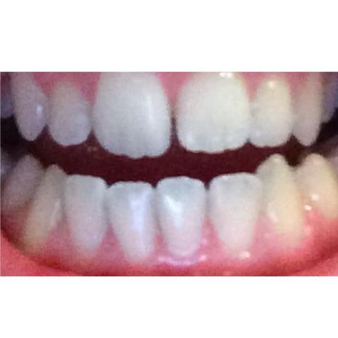 Meine Zähne mit den Zacken an den vorderen Zähnen oben und unten. - (Arzt, Zähne, Zahnarzt)