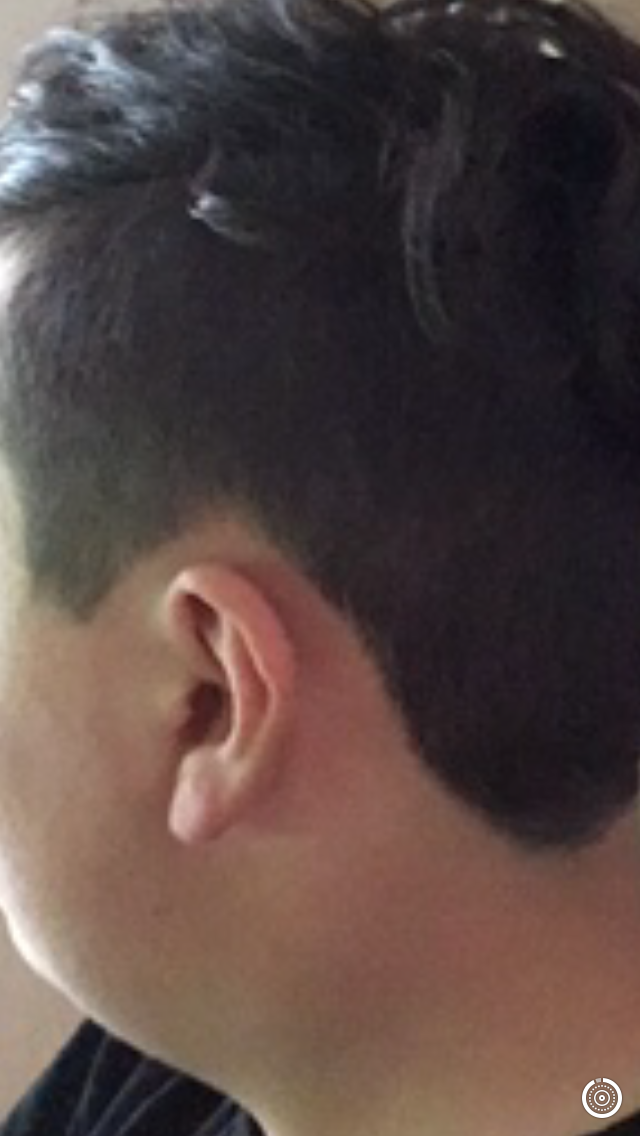 haare implantieren lassen