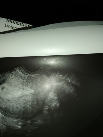 - (Hormone, Kinderwunsch Schwangerschaft)