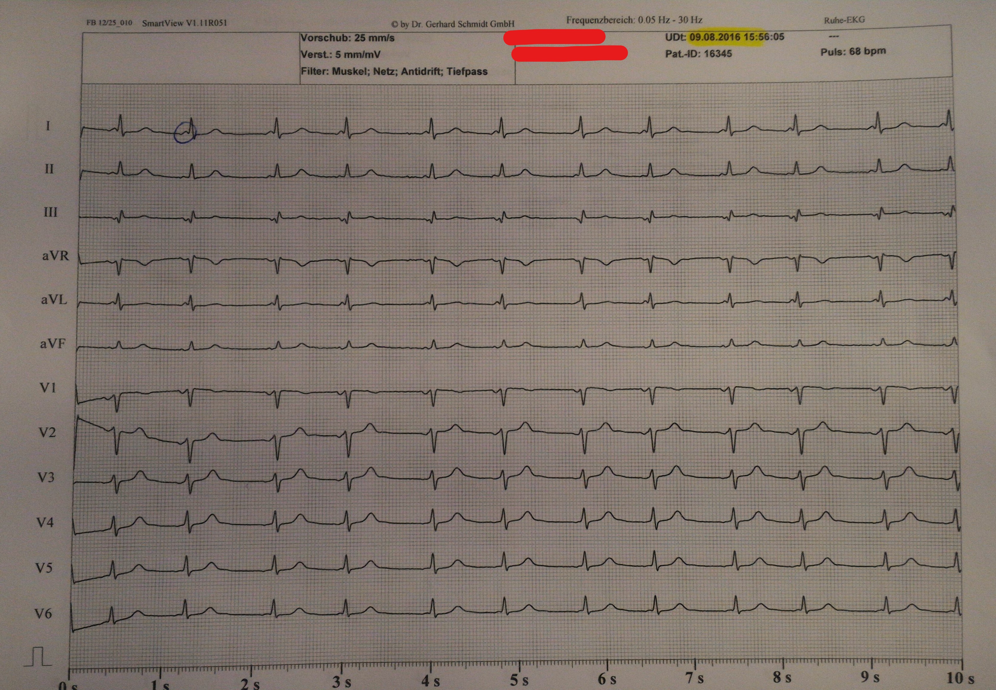 Kann jemand dieses EKG bewerten? Brauche Hilfe!? (Medizin, Arzt, Herz)