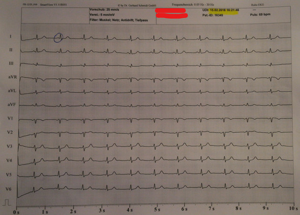 Kann jemand dieses EKG bewerten? Brauche Hilfe!? (Medizin, Arzt, Herz)