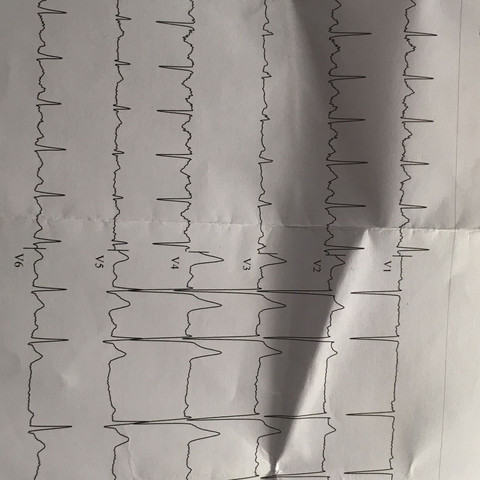 Das ist das EKG Bild. 
Bitte um Hilfe bin verzweifelt. - (Gesundheit und Medizin, Gesundheit, Medizin)