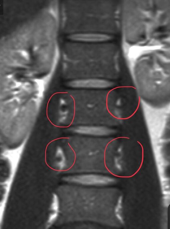 Kann Jemand Magnetresonanz Mrt Bilder Bewerten Arzt Wirbelsaule Bandscheibenvorfall Kann Jemand Magnetresonanz Mrt Bilder Bewerten Arzt Wirbelsaule Bandscheibenvorfall