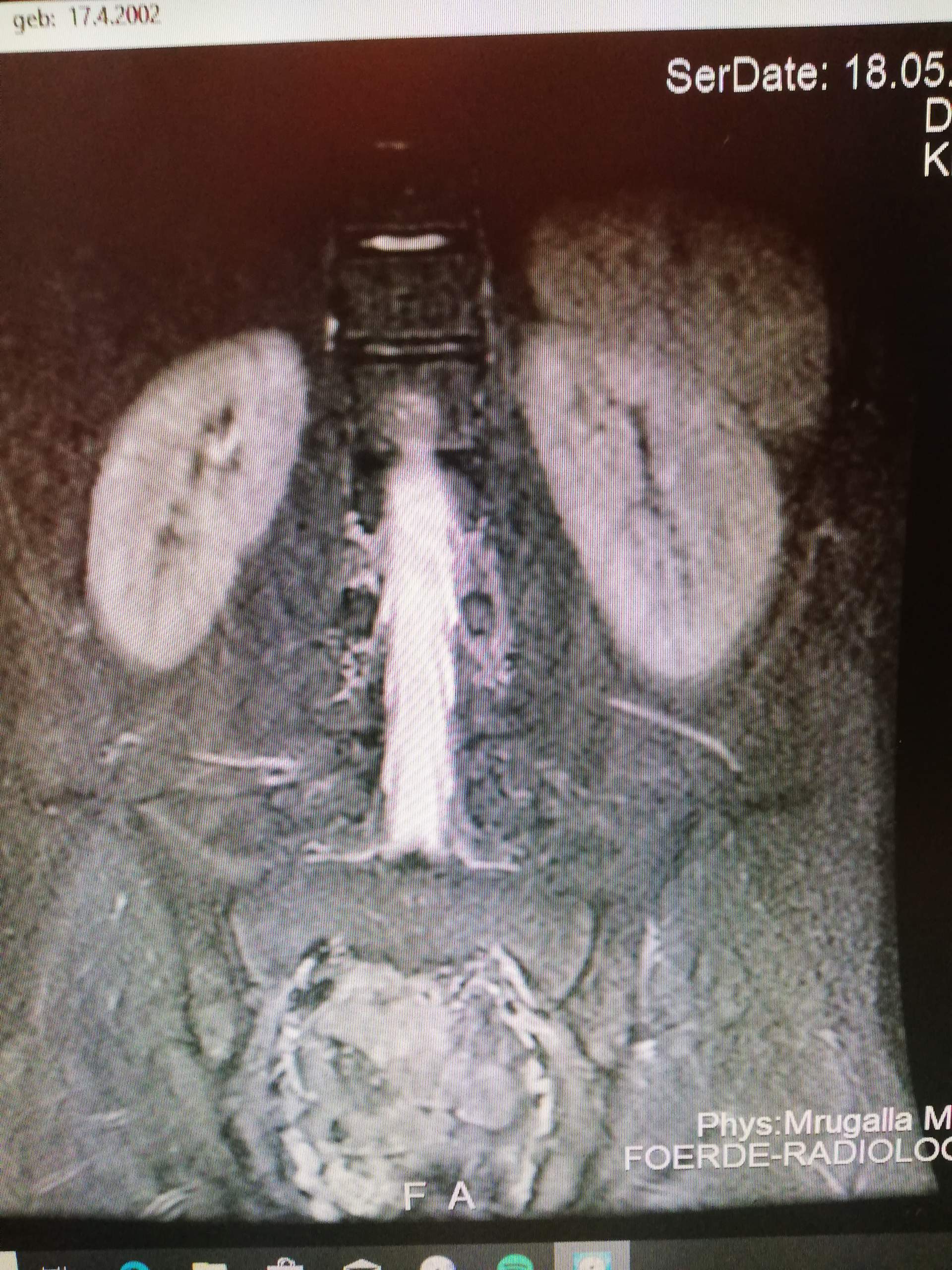 Lumbale radikulopathie: klinik steht vor bildgebung Kann jemand was mit den MRT bildern anfangen von der lws und mir ne