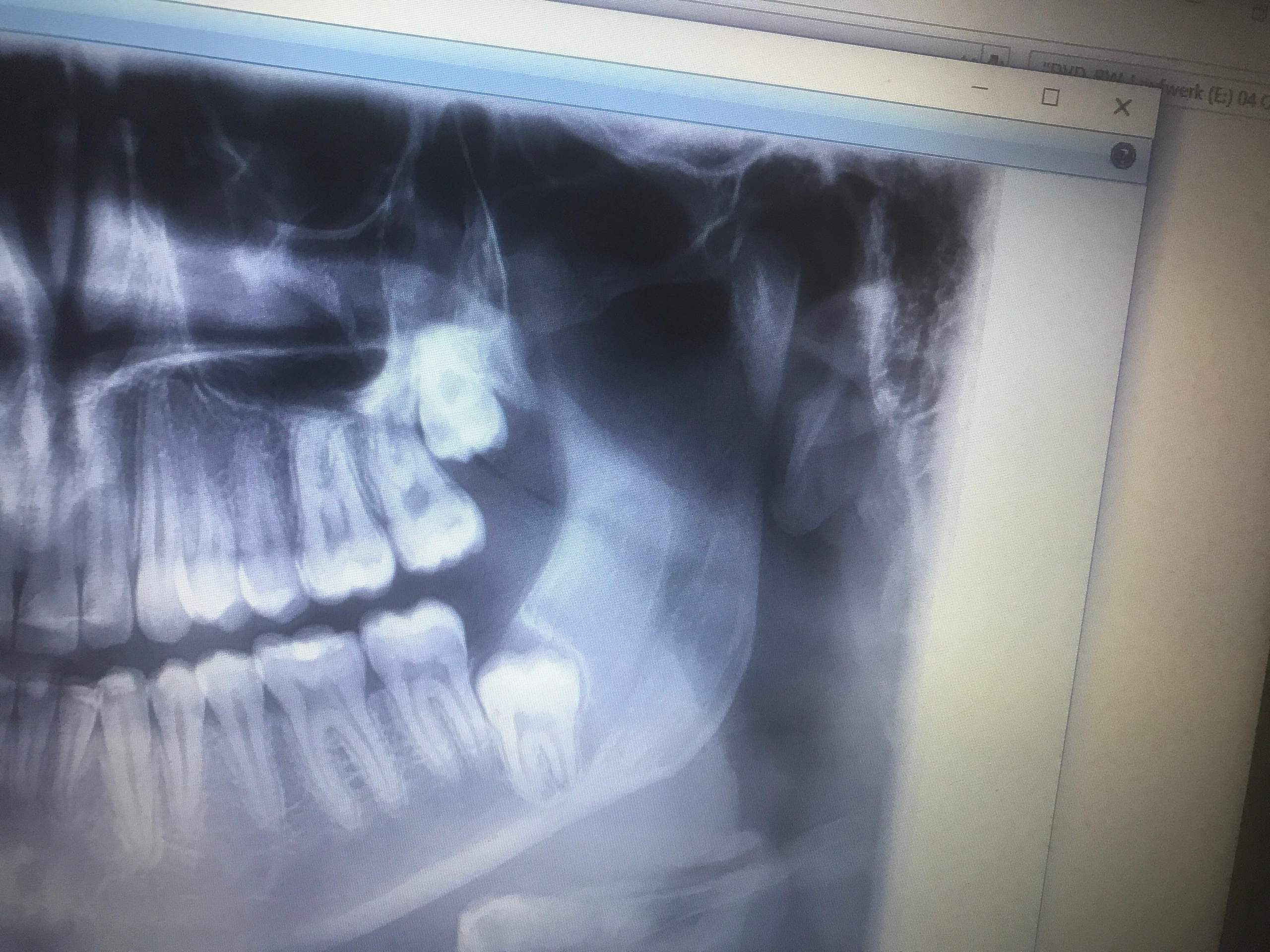 Kann man an diesem Röntgenbild Karies erkennen? (Gesundheit und Medizin ...
