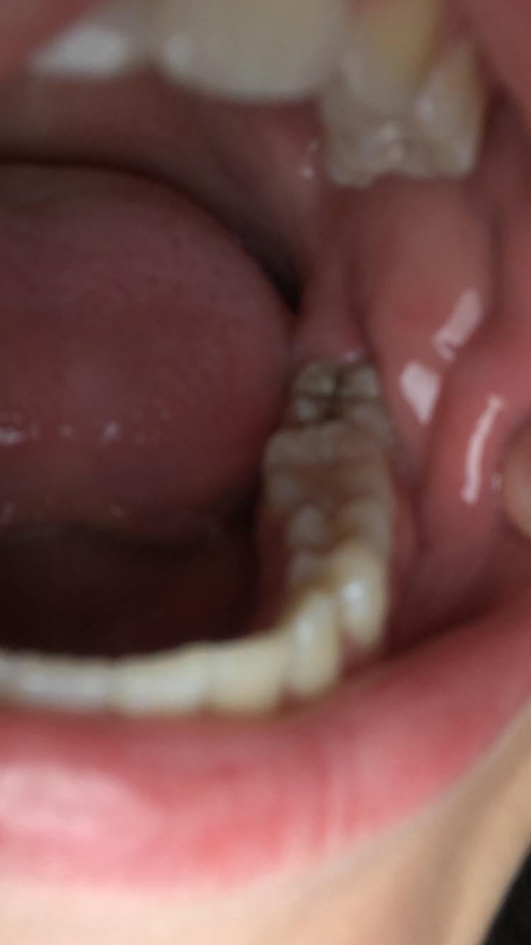 Kann Man Den Retten Zahne Karies Kann Man Den Retten Zahne Karies