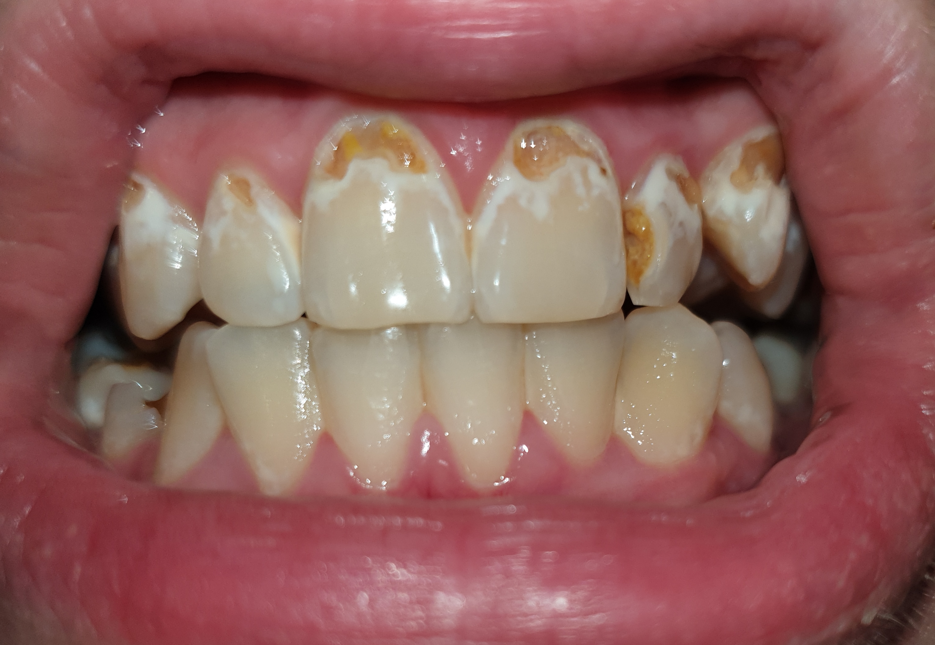 Kann Man Die Zahne Noch Retten Hab Insgesamt 9 Locher Zahnarzt Zahnarztangst Kann Man Die Zahne Noch Retten Hab Insgesamt 9 Locher Zahnarzt Zahnarztangst