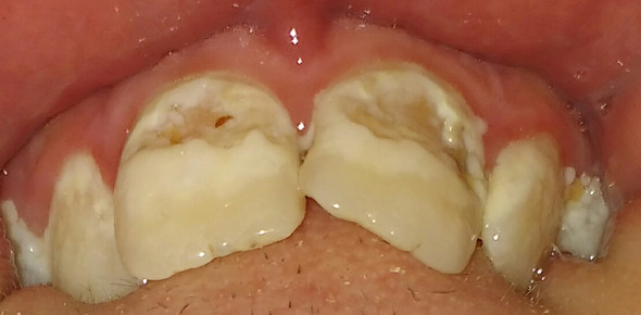 Kann Man Die Zahne Noch Retten Zahnarzt Zahnpflege Zahnarztangst Kann Man Die Zahne Noch Retten Zahnarzt Zahnpflege Zahnarztangst