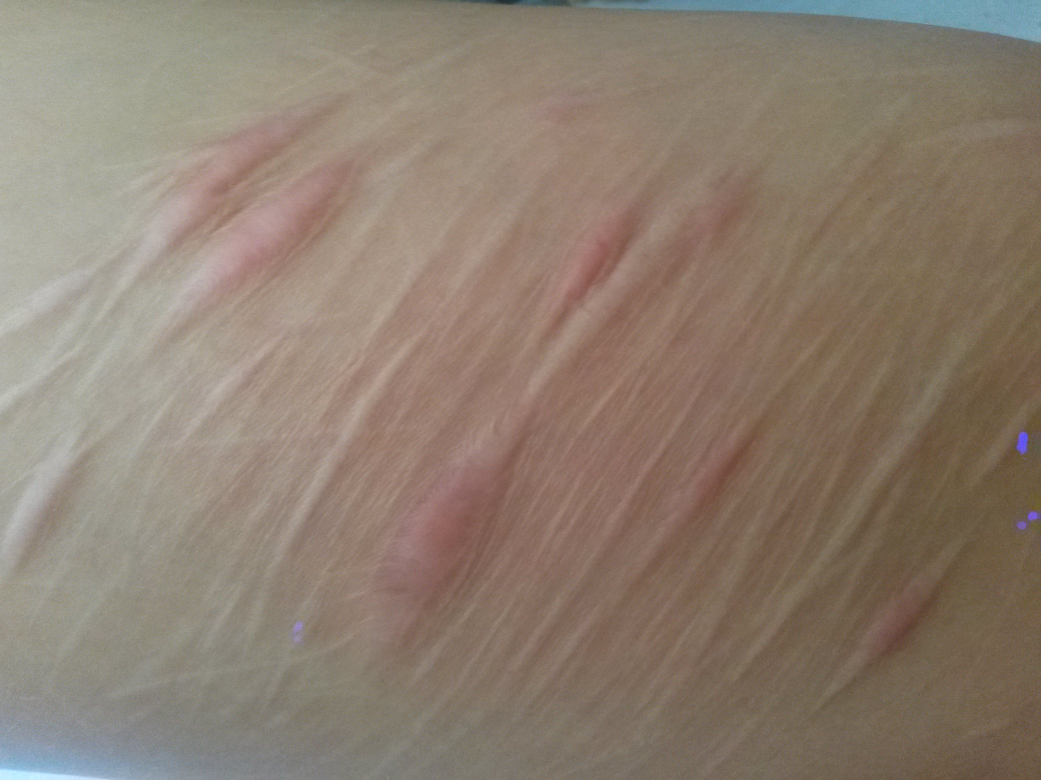 Kann man diese Narben weglasern oder wegschleifen? (Laser, Laserbehandlung)