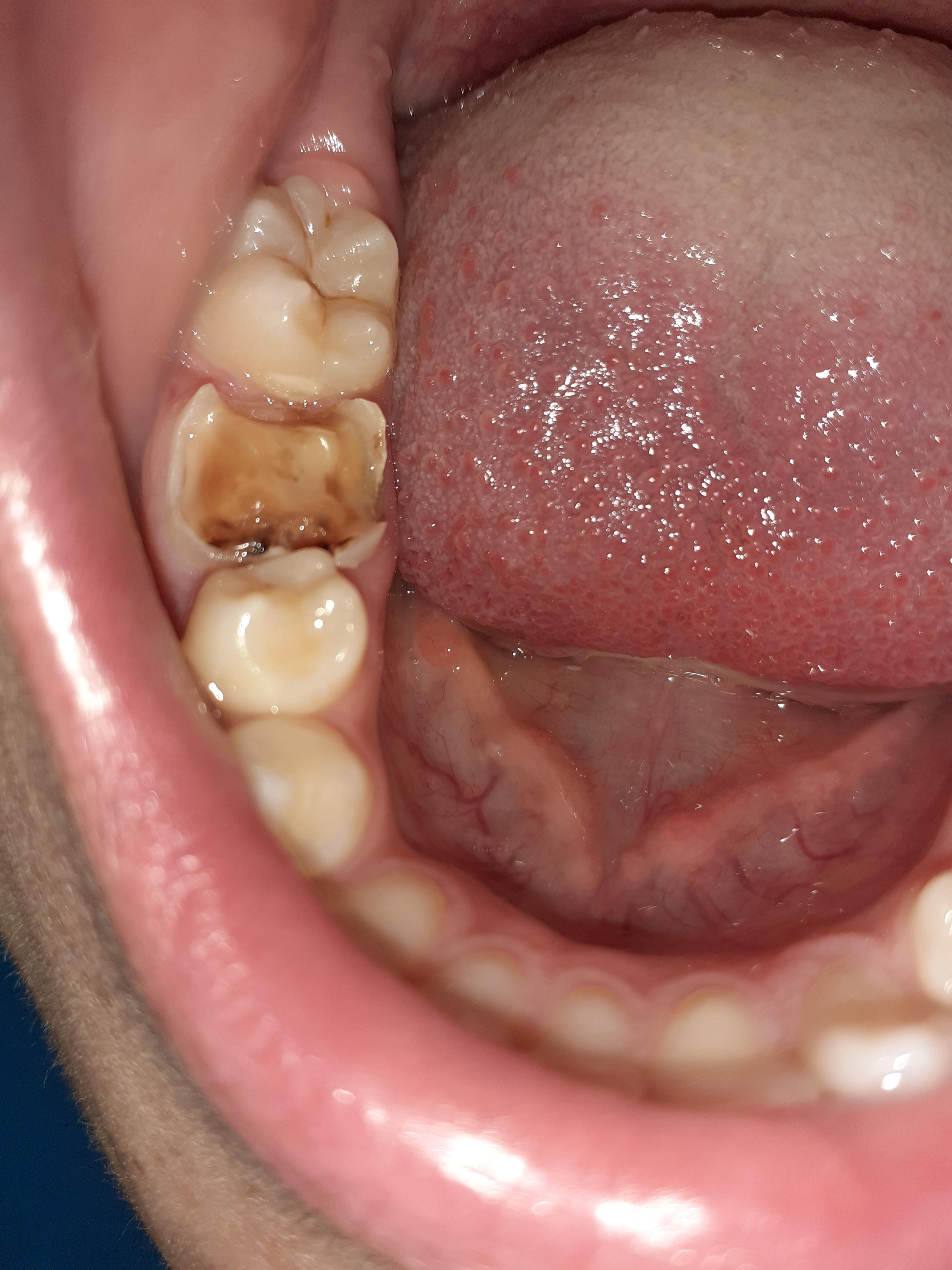 Kann Man Diesen Zahn Noch Retten Zahne Zahnschmerzen Kann Man Diesen Zahn Noch Retten Zahne Zahnschmerzen