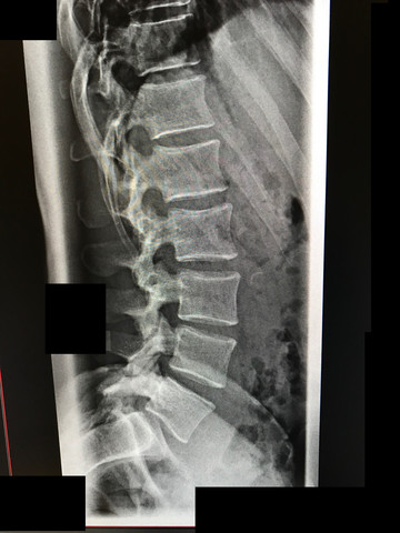 Röntgenaufnahme seite - (Orthopädie, Bandscheibenvorfall, isg-blockade)
