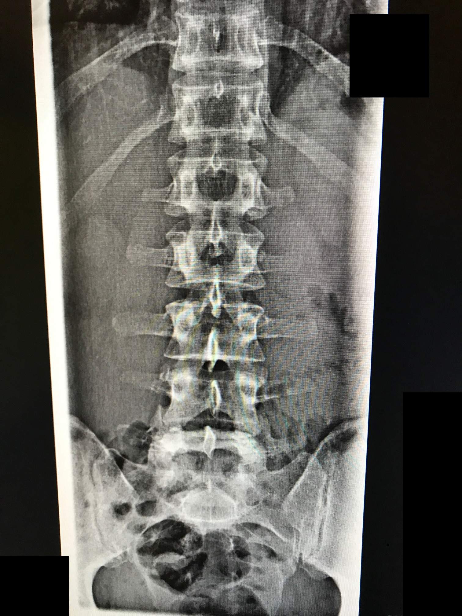 Kann man durch die angehängten Röntgenbilder einen Bandscheibenvorfall