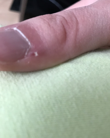 Hiv durch lusttropfen am finger