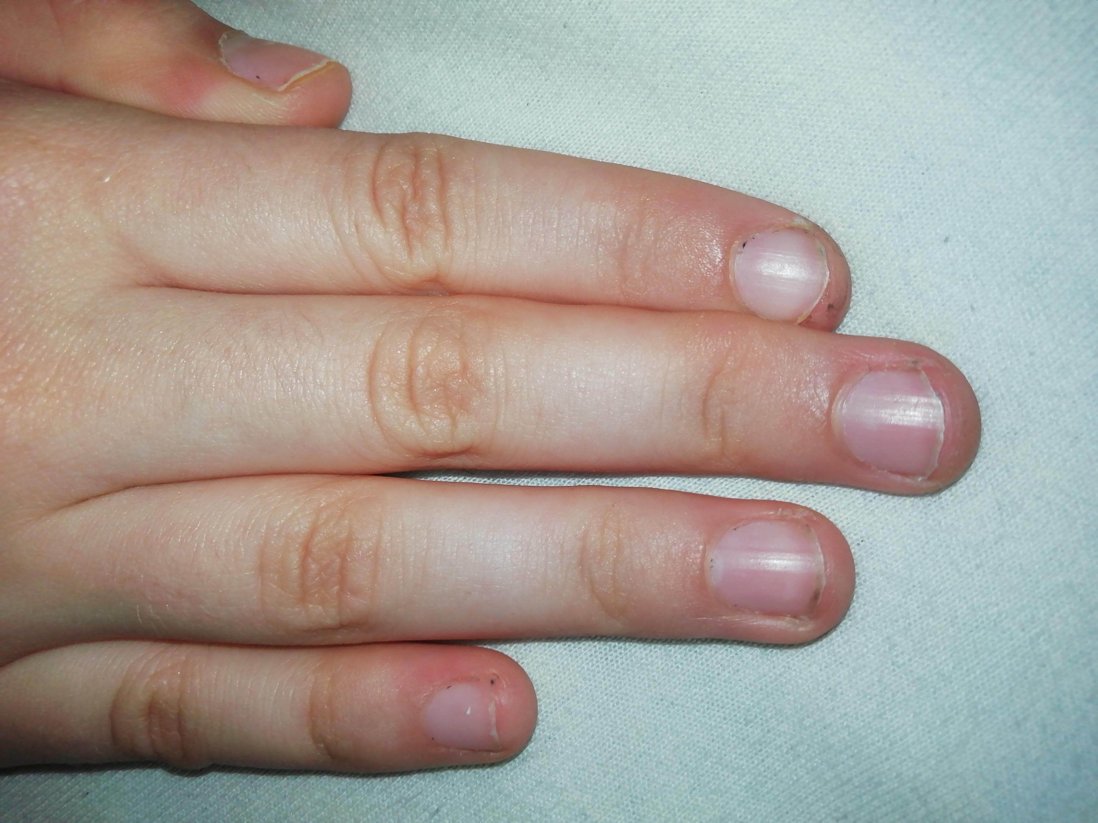 Kann Man Meine Fingernagel Noch Retten Nagel Nagelkauen