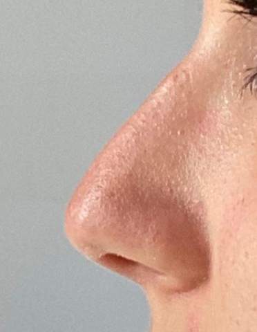 Kann man mit 16 seine Nase operieren? (Gesundheit, Schönheits-OP)