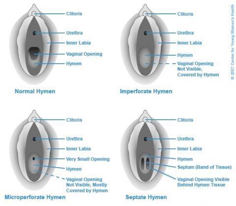 Kann Man Mit Einem Septum Jungfernhautchen Entjungfert Werden Gesundheit Sex Kann Man Mit Einem Septum Jungfernhautchen Entjungfert Werden Gesundheit Sex