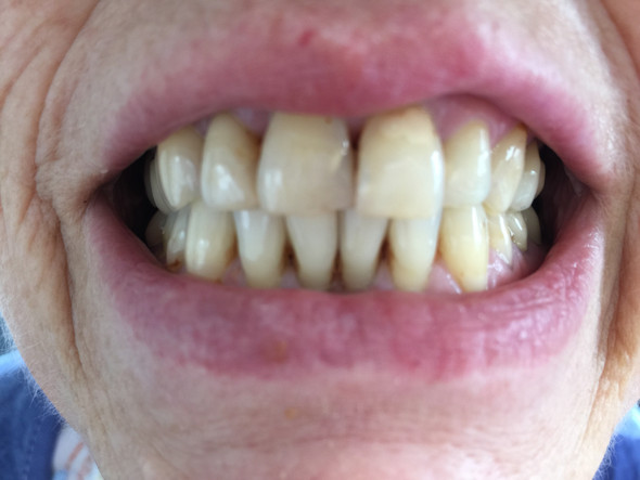 Vorher - (Zahnarzt, Zahnmedizin, Zahnersatz)