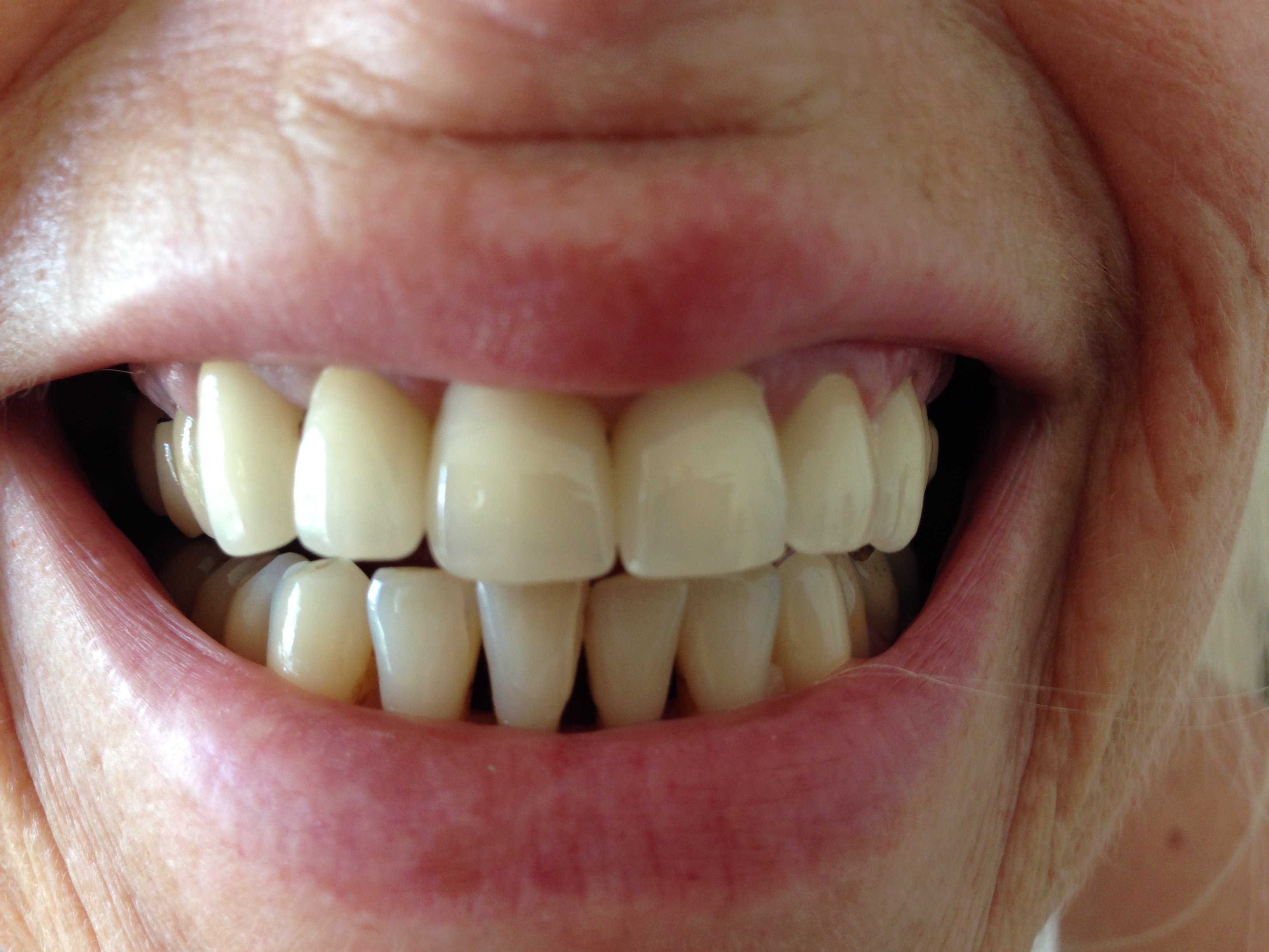 Kann man nicht passende Zahnkronen ablehnen? (Zahnarzt, Zahnmedizin Kann man nicht passende Zahnkronen ablehnen? (Zahnarzt, Zahnmedizin