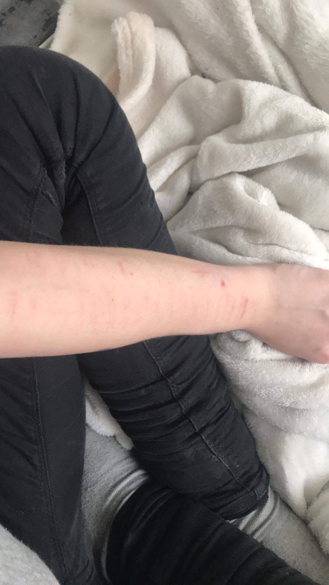 Kann Man Svv Narben Ubertatowieren Tattoo