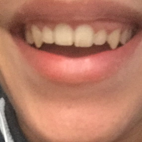 Kann Man Zahne Schleifen Lassen Kann Man Zahne Schleifen Lassen