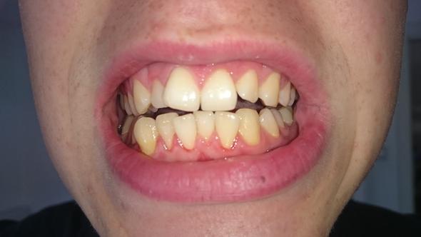 Zahnfehlstellung - (Zahnarzt, Zahnspange, Kieferorthopäde)
