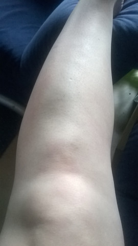 Kann Mir Einer Mit Der Schwellung Am Schienbein Helfen Gesundheit Orthopadie Kann Mir Einer Mit Der Schwellung Am Schienbein Helfen Gesundheit Orthopadie