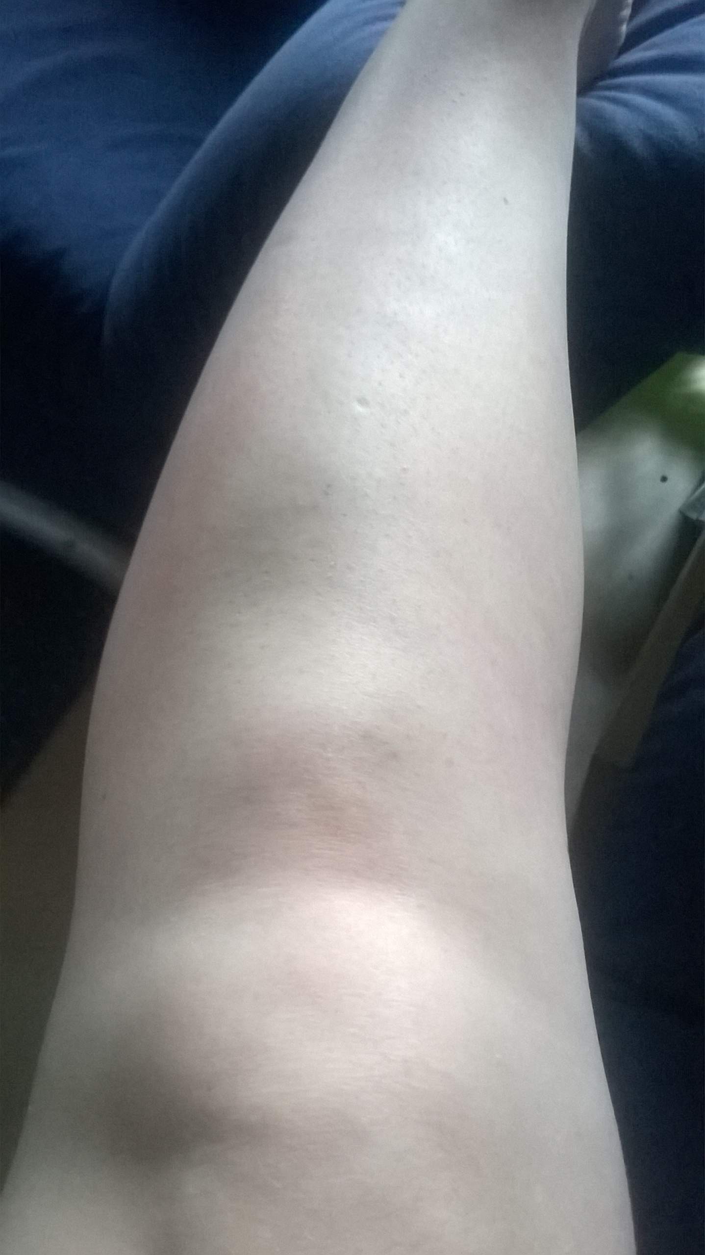 Dauer innenbandzerrung knie Innenbandzerrung Knie