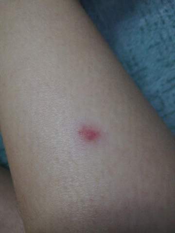 Kann Mir Einer Sagen Was Das Fur Ein Roter Fleck Am Bein Ist Gesundheit Und Medizin Roter Fleck Kann Mir Einer Sagen Was Das Fur Ein Roter Fleck Am Bein Ist Gesundheit Und Medizin Roter Fleck