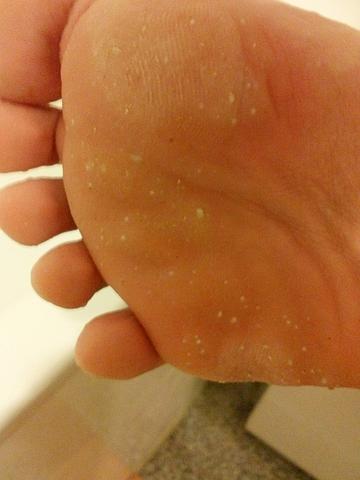 Kann Mir Einer Sagen Was Das Ist Warzen Ausschlage Fusssohle Gesundheit Haut Fusse Kann Mir Einer Sagen Was Das Ist Warzen Ausschlage Fusssohle Gesundheit Haut Fusse