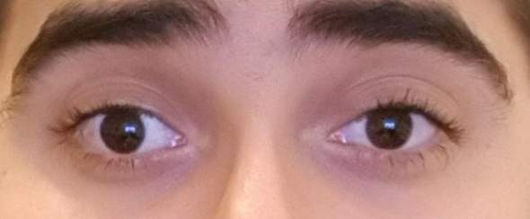 Kann Mir Jemand Ein Paar Fragen Beantworten Schielen Auge Gesundheit Und Medizin Augen