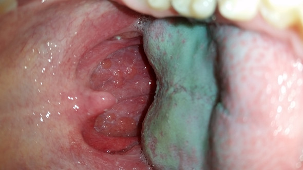 Kann Mir Jemand Helfen Krankheit Schmerz Beim Schlucken Kann Mir Jemand Helfen Krankheit Schmerz Beim Schlucken