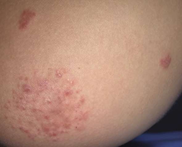 Kann mir jemand sagen was das auf meiner Haut ist? (Gesundheit und Medizin)