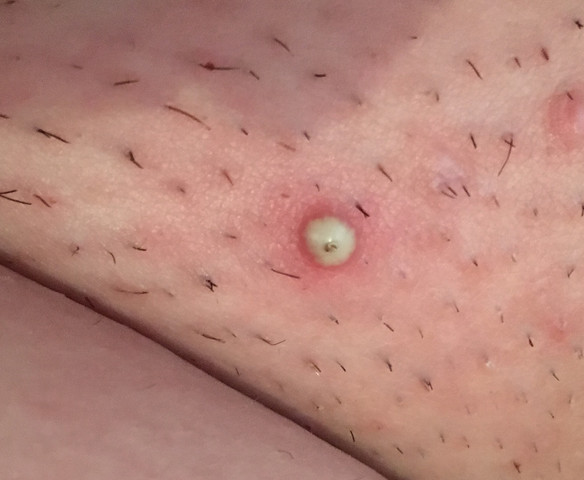 Kann Mir Jemand Sagen Was Das Ist Pickel Gesundheit Kann Mir Jemand Sagen Was Das Ist Pickel Gesundheit