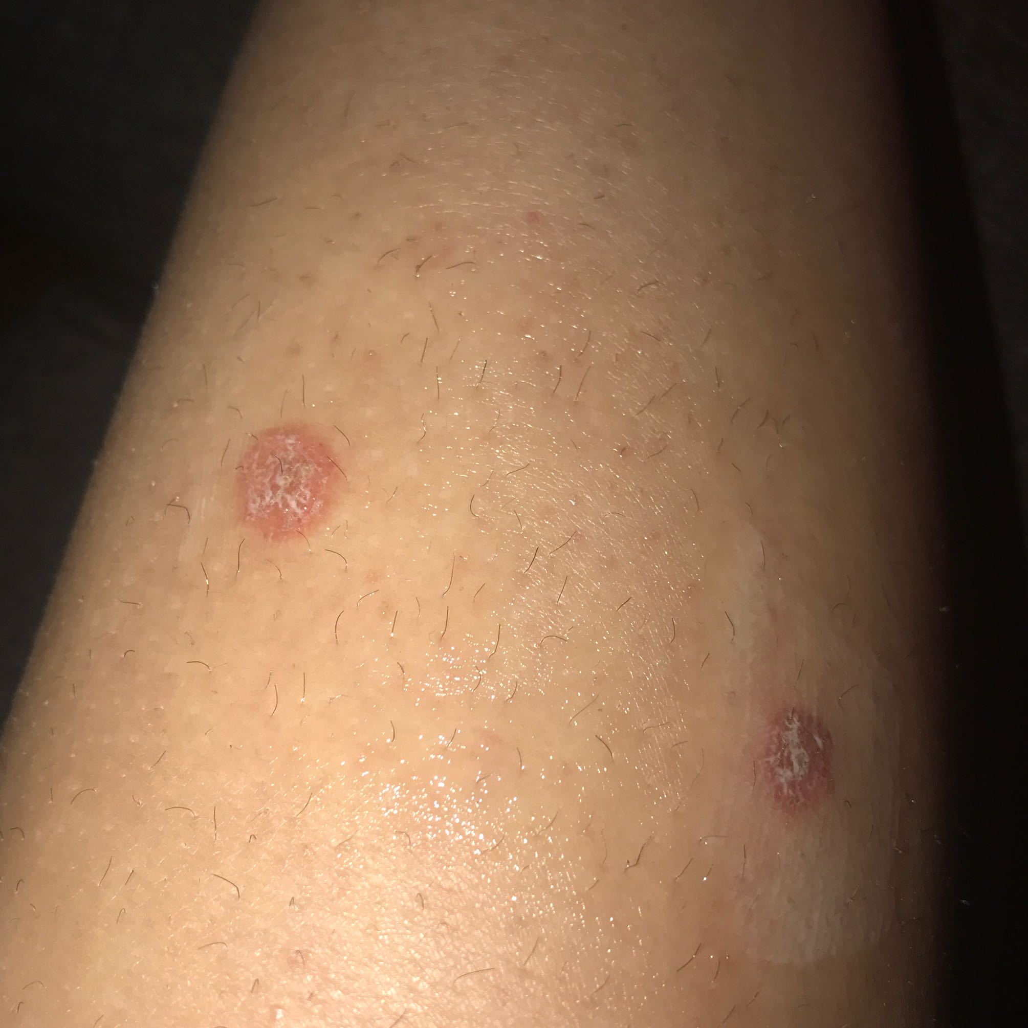 Kann mir jemand sagen was das ist?Hautpilz? (Gesundheit und Medizin, Ausschlag, jucken) Kann mir jemand sagen was das ist?Hautpilz? (Gesundheit und Medizin, Ausschlag, jucken)