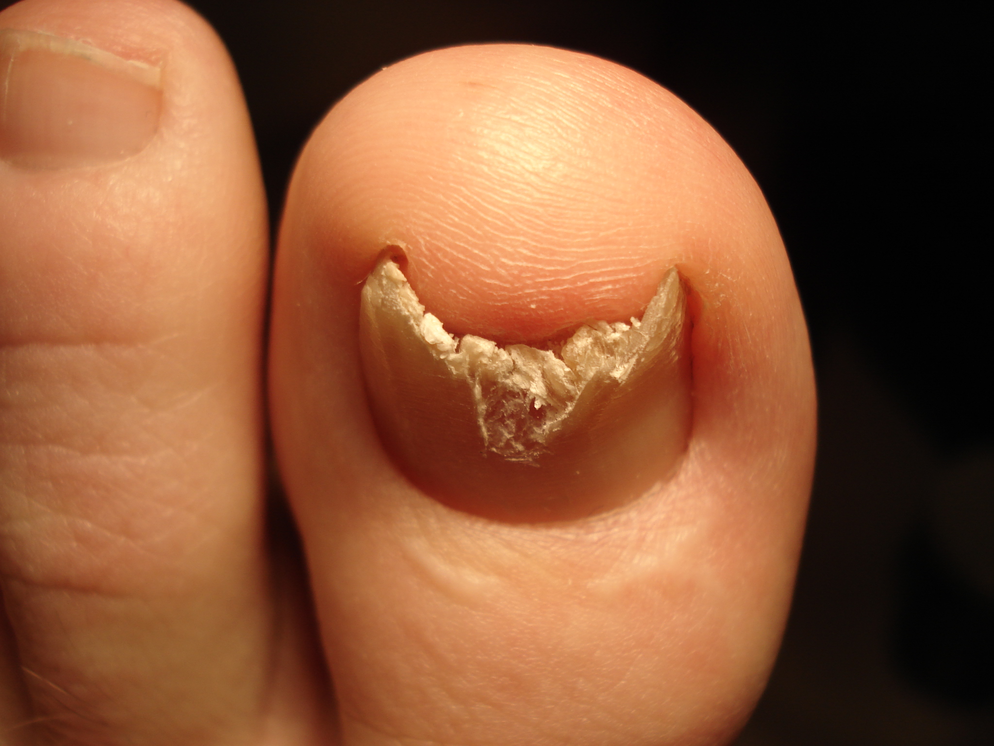 Kann mir jemand sagen, was mit meinem rechten Zehennagel los ist (Nagelprobe auf Pilz negativ Kann mir jemand sagen, was mit meinem rechten Zehennagel los ist (Nagelprobe auf Pilz negativ